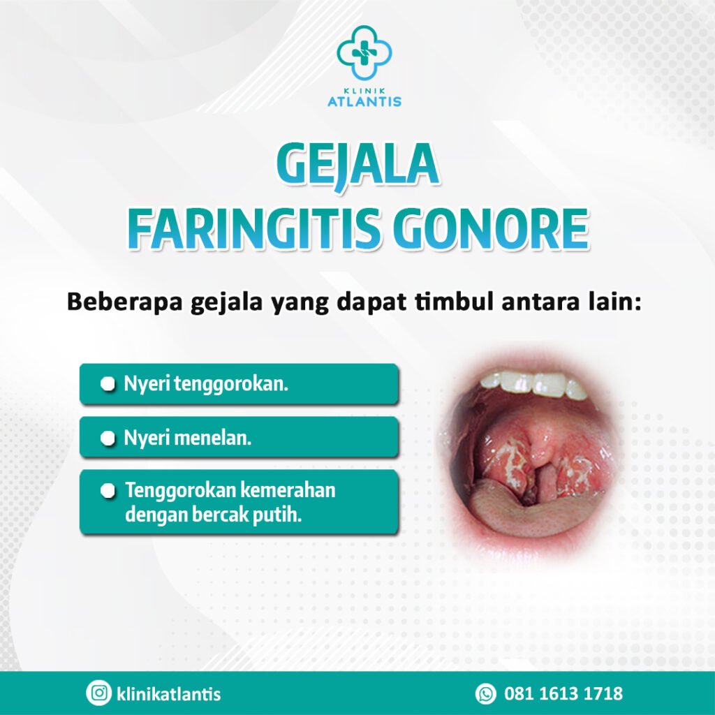 gejala faringitis gonore