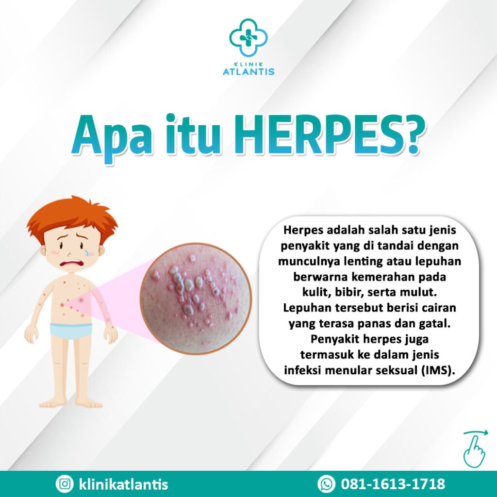 herpes